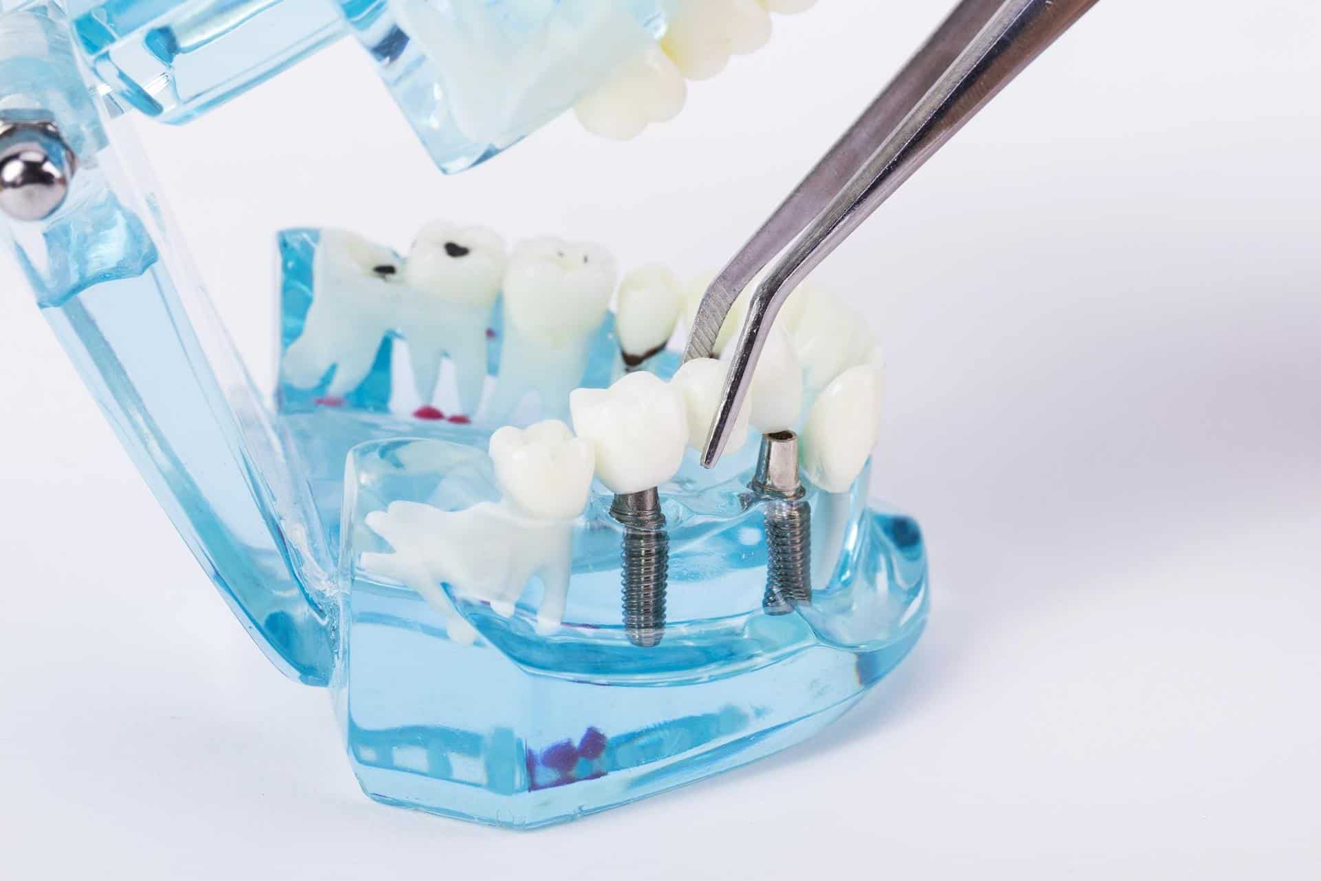 缺牙要植牙還是做牙橋 做牙橋會牙齦腫痛 裝牙橋優缺點 清潔保養看這篇