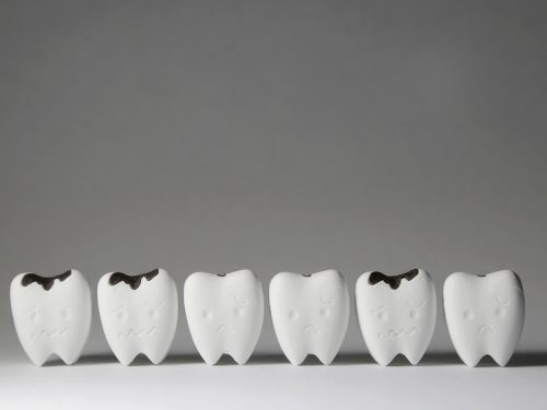 蛀牙太深只能抽神經？活髓保存術＋陶瓷嵌體完整治療方案費用、流程解說