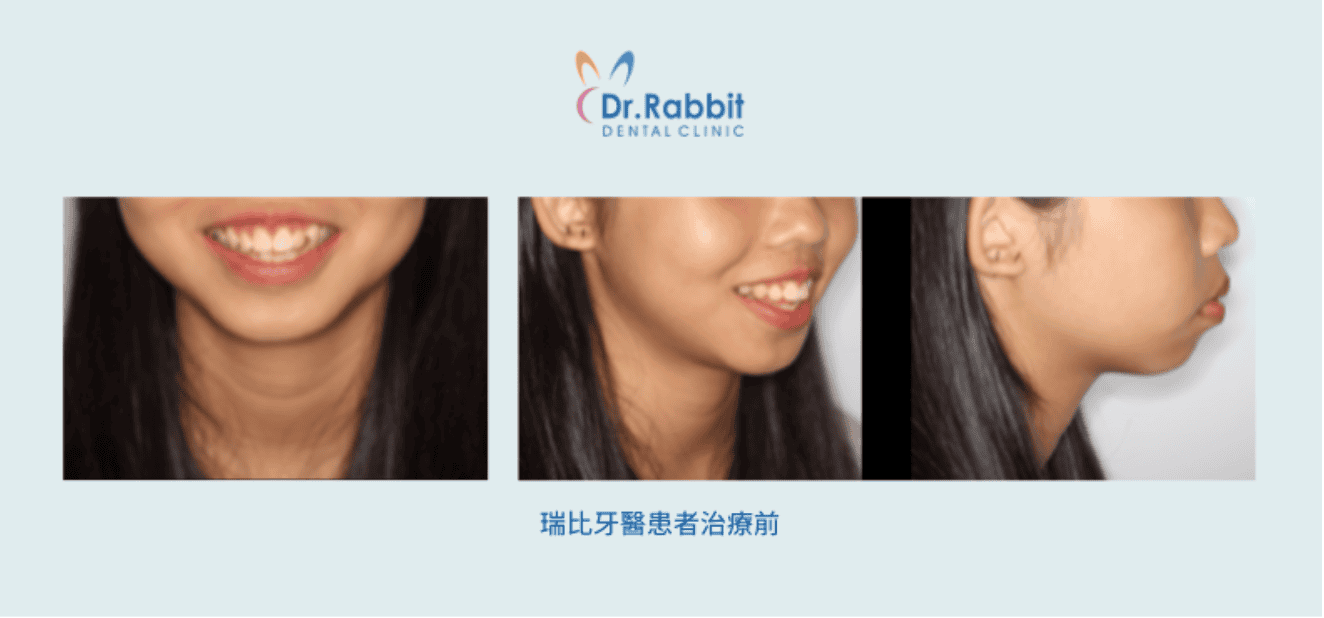 drrabbit-Protruding Mouth Correction Are Invisalign Suitable for Those with Straight Teeth but a Protruding Mouth?-2