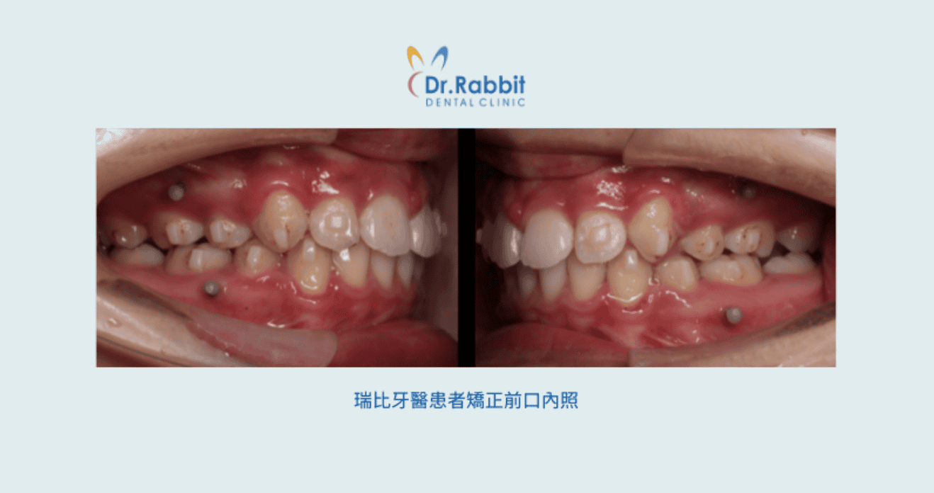 drrabbit-Protruding Mouth Correction Are Invisalign Suitable for Those with Straight Teeth but a Protruding Mouth?-3