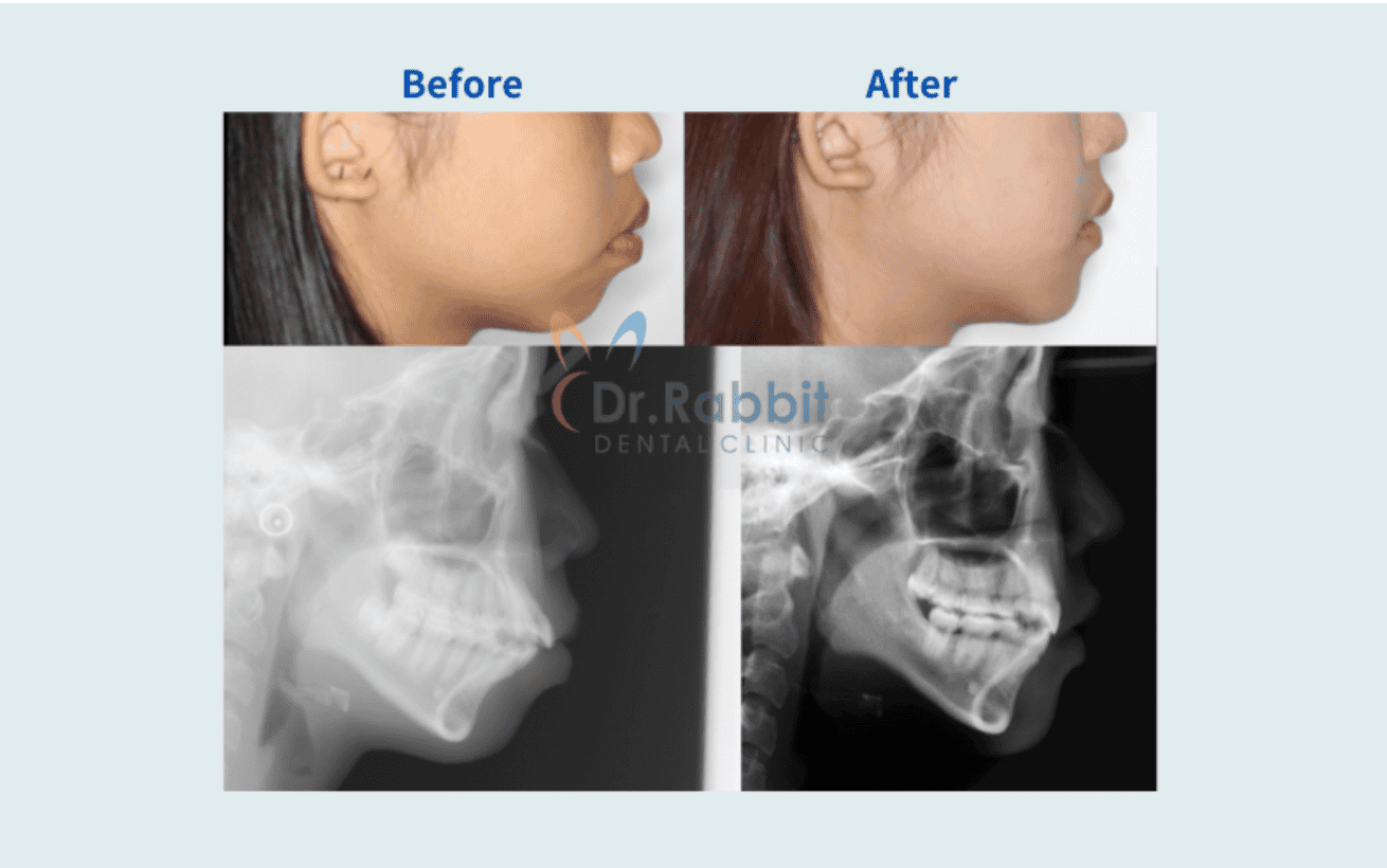 drrabbit-Protruding Mouth Correction Are Invisalign Suitable for Those with Straight Teeth but a Protruding Mouth?-4