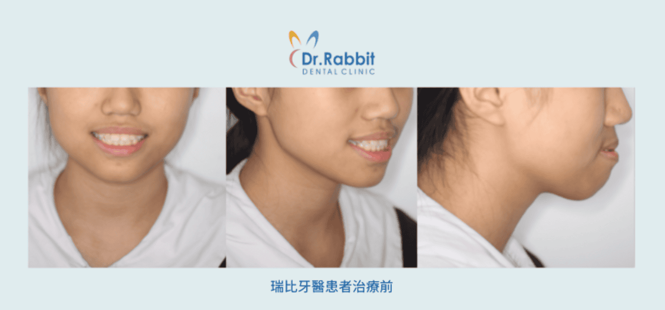 drrabbit-Protruding Mouth Correction Are Invisalign Suitable for Those with Straight Teeth but a Protruding Mouth?-5