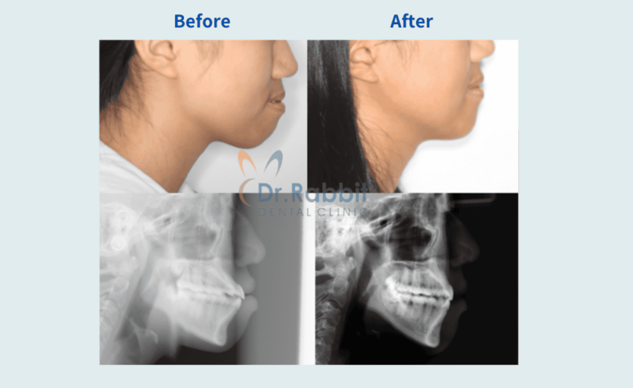 drrabbit-Protruding Mouth Correction Are Invisalign Suitable for Those with Straight Teeth but a Protruding Mouth?-6