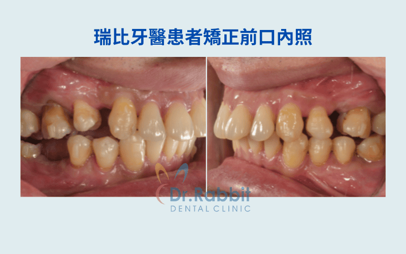瑞比牙醫患者矯正前口內照