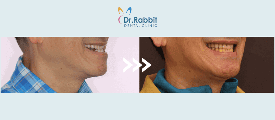 戽斗隱適美矯正案例