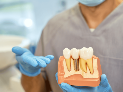 植牙疑問全解答：過程、時間、疼痛、一定要補骨粉嗎？