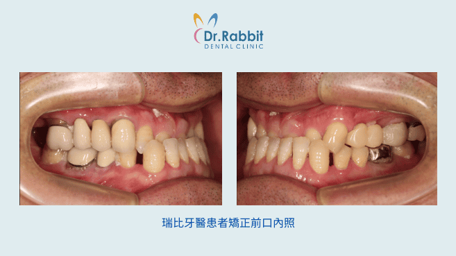 骨性戽斗矯正前口內照