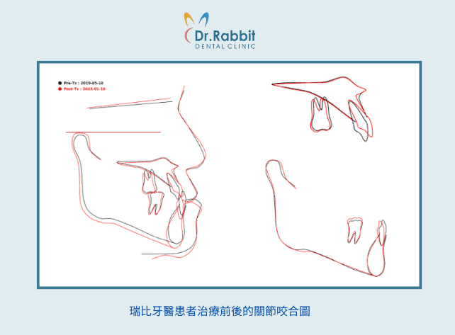 骨性戽斗矯正前後關節咬合圖