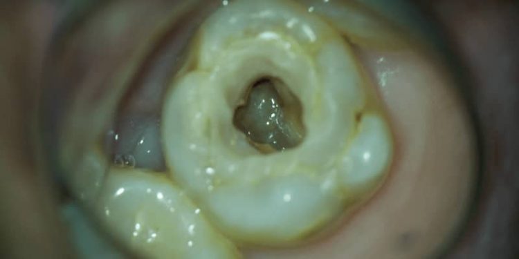 使用顯微根管看到的牙齒-瑞比牙醫診所