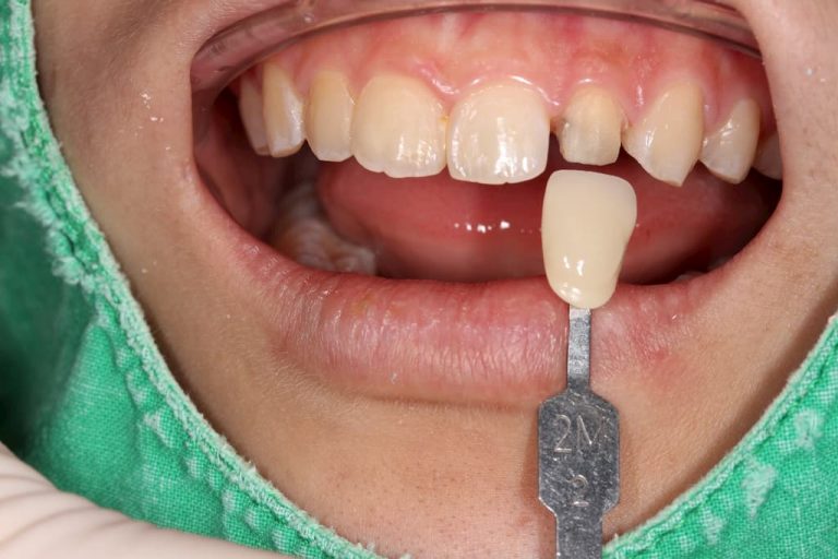 假牙復形-22-側門牙術前