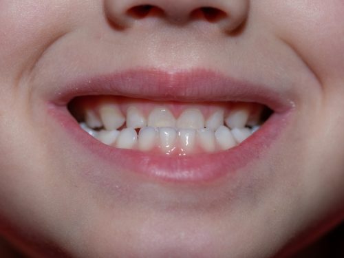 咬合不正、臉型、下巴歪成因及影響爲何？牙齒一定要矯正嗎？
