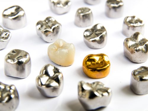全金屬、全瓷冠、金屬烤瓷、全鋯冠，牙冠材質種類怎麼選？裝假牙牙套還會蛀牙嗎？
