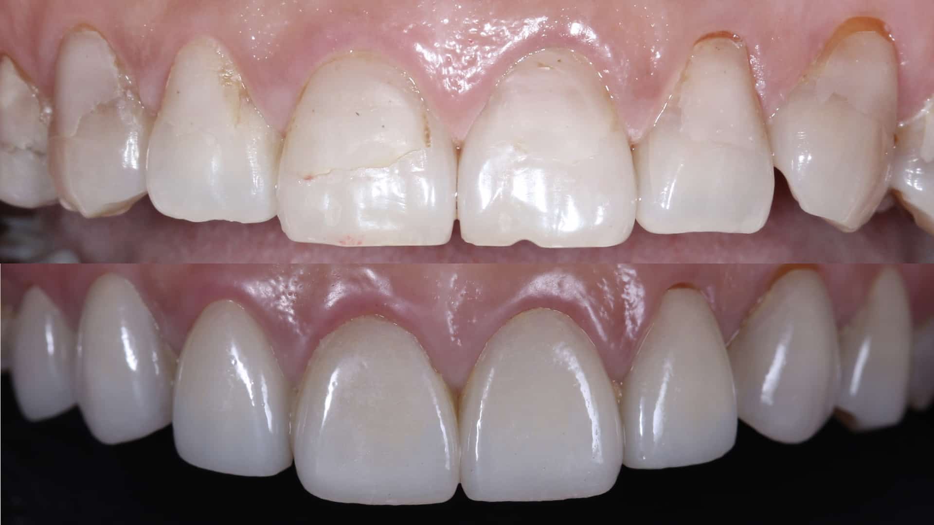 圖三、施作貼片後，保留牙齒本身弧度效果更自然（圖片來源：瑞比牙醫）