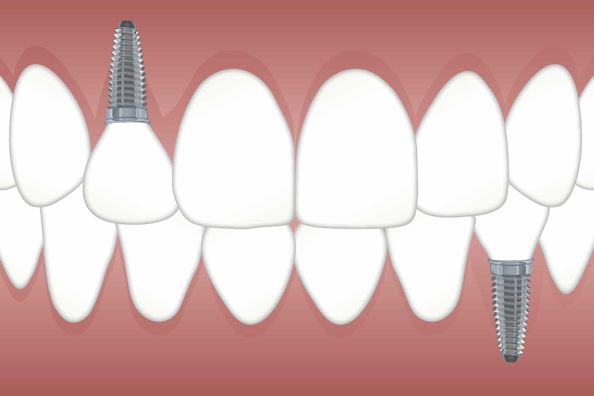 圖說、植牙會將植體植入骨頭取代原本牙根，除了恢復咬合能力還能持續刺激牙床減緩萎縮（圖片來源：Pixabay）