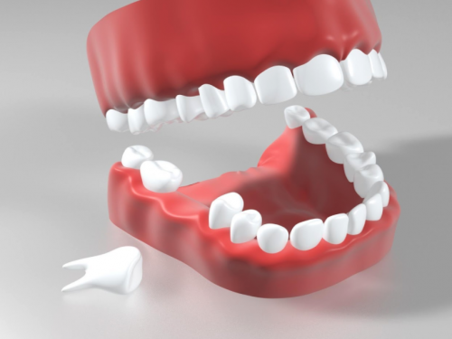 缺牙該植牙還是做假牙？植牙要保險嗎？微創治療有哪些好處、後遺症？注意事項一次了解！