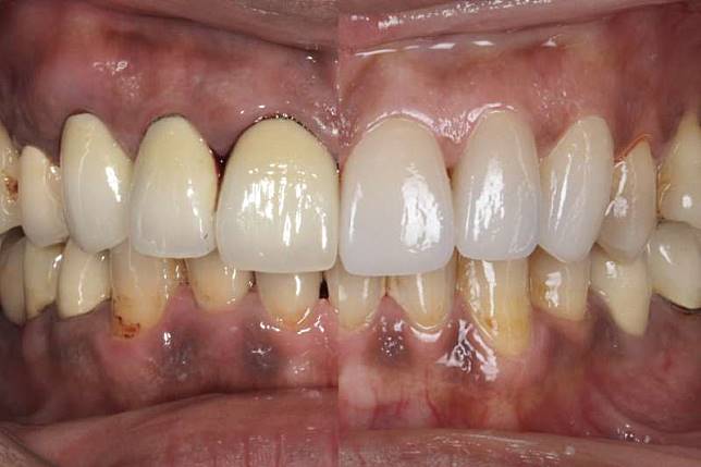 牙齒整齊但牙周色素沈澱仍相當不美觀（左圖），陶瓷貼片（右上圖）可讓笑容更加完美