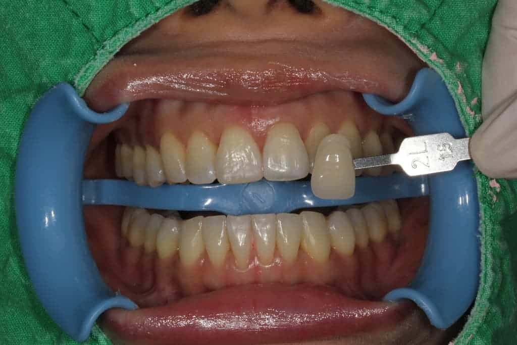 牙齒美白服務-冷光美白術前-瑞比牙醫