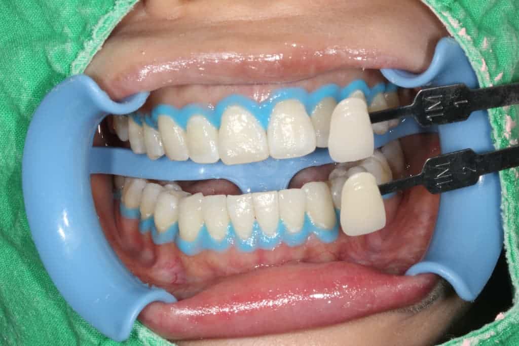 牙齒美白服務-冷光美白術後-瑞比牙醫