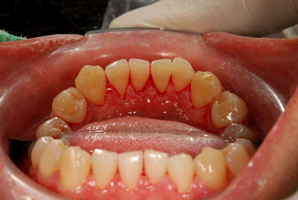 牙齒美白噴砂術後