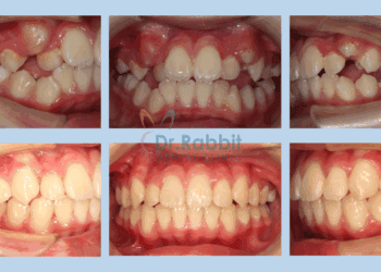 牙齒美白貼片改善齒色不均，也讓齒緣變得平整。