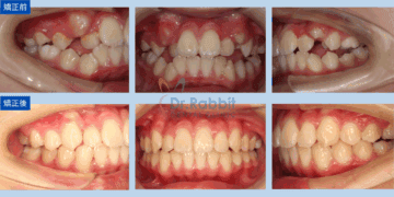 牙齒美白貼片改善齒色不均，也讓齒緣變得平整。