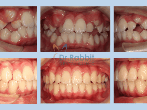 虎牙矯正一定要拔牙嗎？隱適美虎牙矯正攻略：成人與兒童案例解析