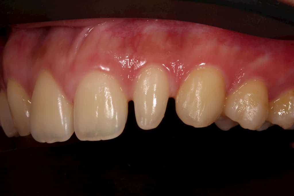 牙齒美白貼片服務-22側門牙術前-瑞比牙醫