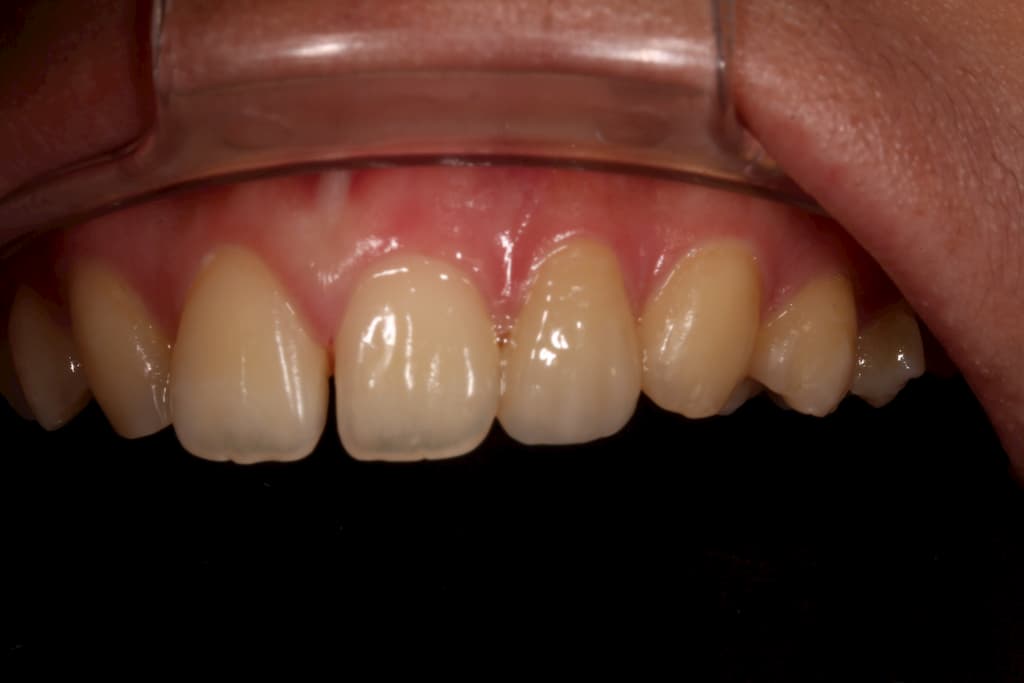 牙齒美白貼片服務-22側門牙術後-瑞比牙醫