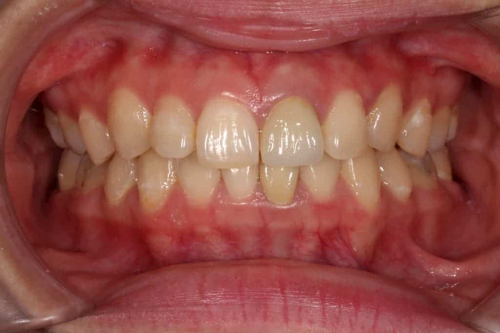 牙齒美白貼片服務-5-5術前-瑞比牙醫