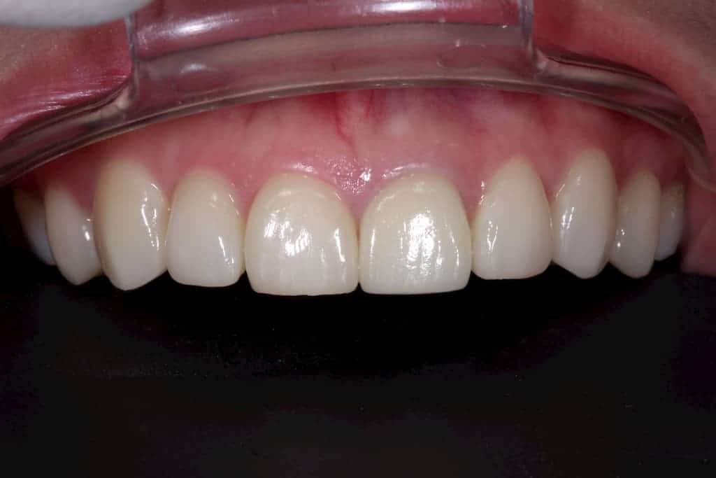 牙齒美白貼片服務-5-5術後-瑞比牙醫