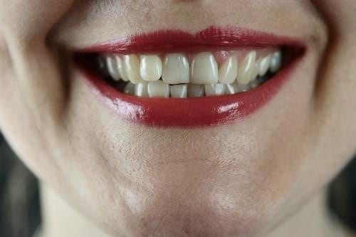 牙齒與牙齦的連接處很容易成為清潔死角，滋生牙菌斑（圖片來源：Unsplash）