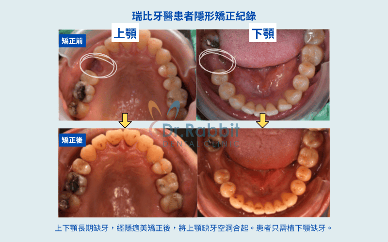 瑞比牙醫患者隱適美矯正紀錄