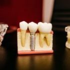 牙周病可以植牙嗎？牙周病會好嗎？牙周三合一療法是什麼？疑問與治療程序一次大公開