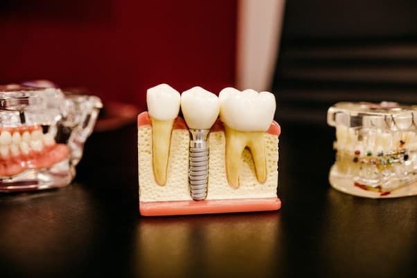 缺牙患者如果有牙周病可以植牙嗎？瑞比牙醫一次解答牙周病相關疑問（圖片來源：Unsplash）