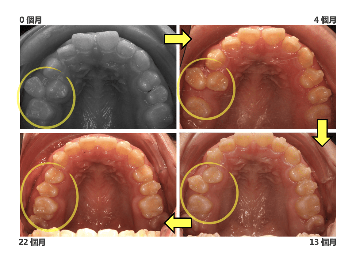 透過隱適美矯正調整齒列空間，許多患者不需拔牙也能改善牙齒並排的狀況