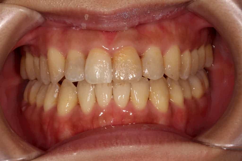 隱適美案例-牙亂咬合不正術後-瑞比牙醫診所