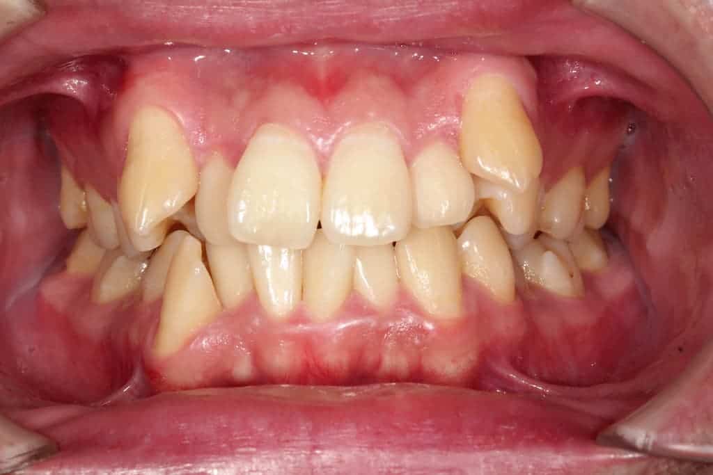 隱適美案例-牙亂術前-瑞比牙醫診所
